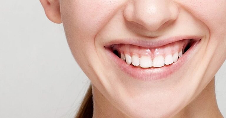 7 Effective Ways to Naturally Get Rid of Your Gummy Smile